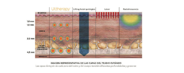 ariadne-artiles-tratamiento-ultherapy-4